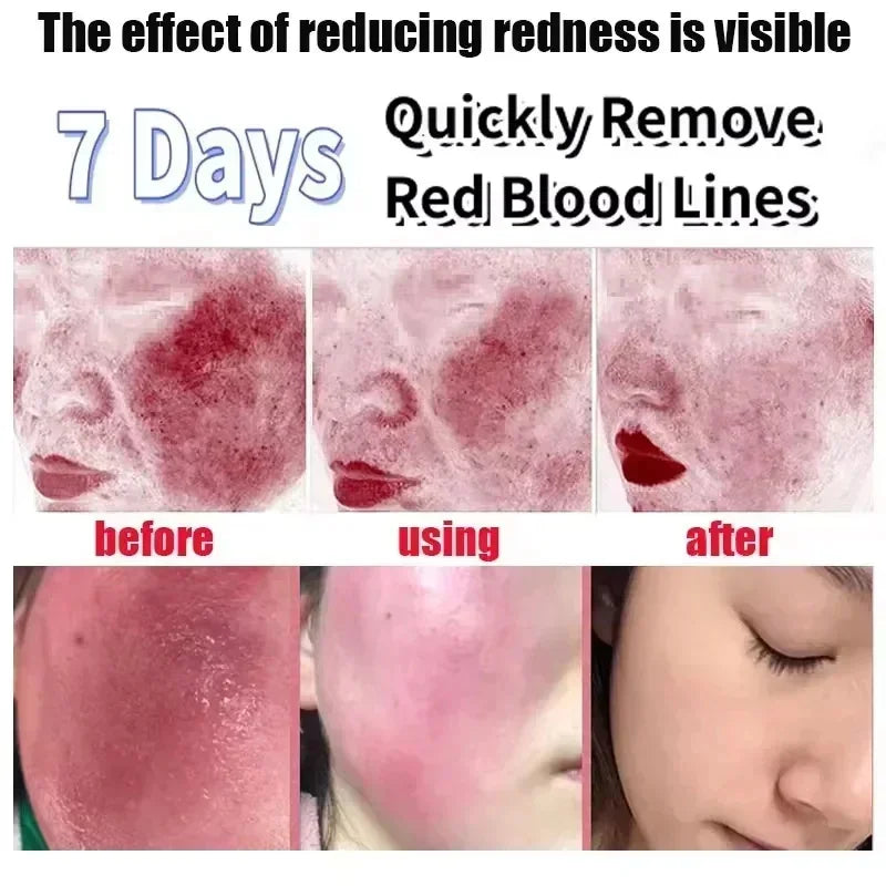Repair Facial Redness Cream Instant Spider Vein Remove Sensitive Skin Sooth Anti Redness Rosacea Treat Lotion Korean Cosmetics