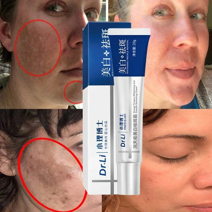 Effective whitening cream for freckles, removes Melasma, dark spots, pigmentation, moisturizer, lightens the face,