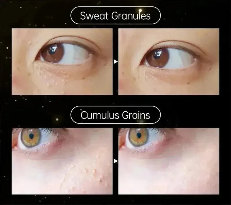 Fat Granules Remover Eye Cream Effective Remove Fat Granules Puffiness Anti-Particles Milia Remover Product Repair Eye Skin Care