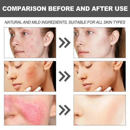 Repair Facial Redness Cream Instant Spider Vein Remove Sensitive Skin Sooth Anti Redness Rosacea Treat Lotion Korean Cosmetics