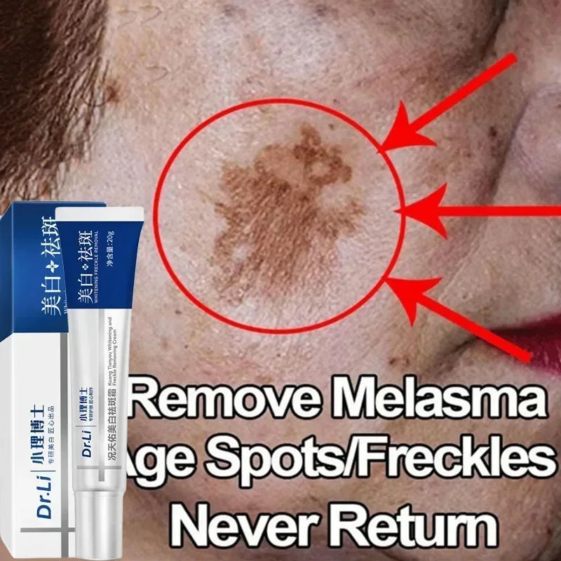 Effective whitening cream for freckles, removes Melasma, dark spots, pigmentation, moisturizer, lightens the face,