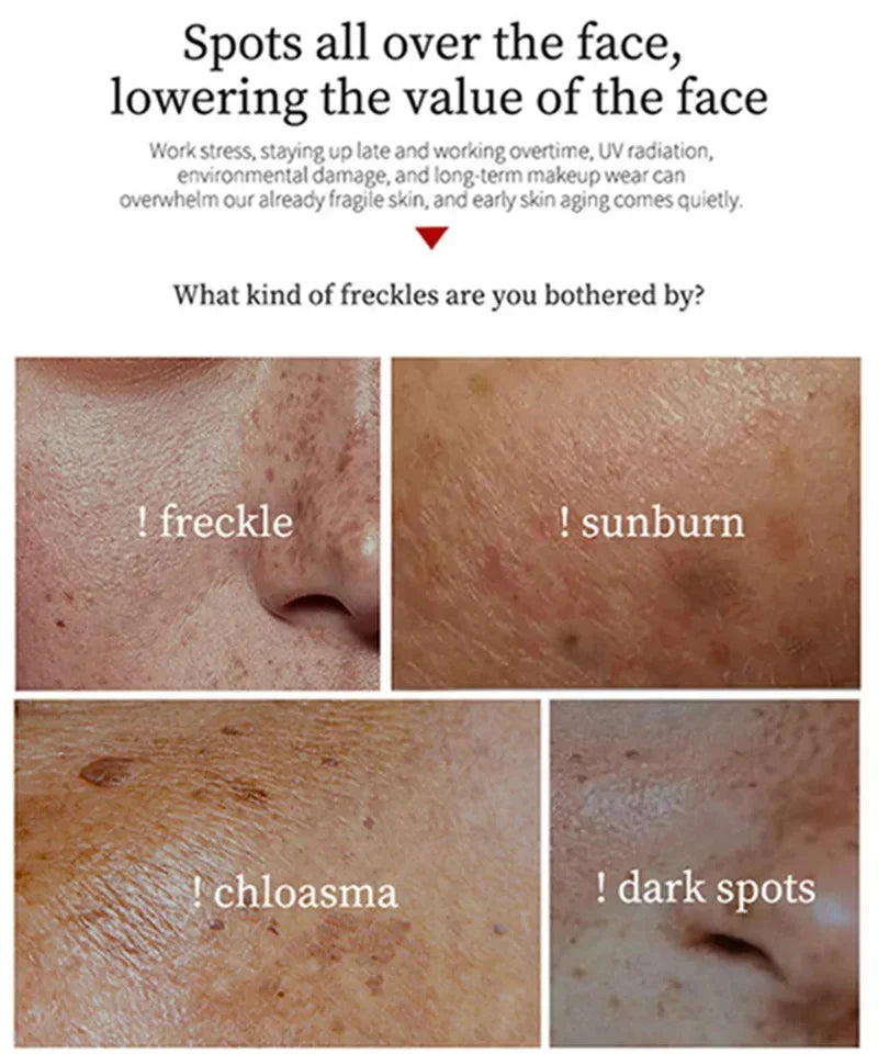 Powerful Spot-removing Whiten Cream Brighten Skin Fast Eliminates Melanin Pigmentation Melasma Dark Spots Moisturize Beauty Gel